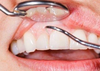Parodontologia - Studio Dentistico Quident a Cannobio