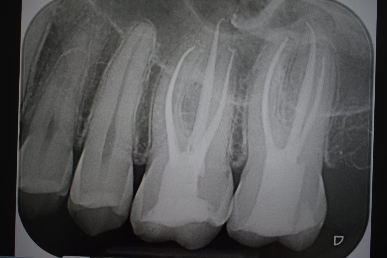 Endodonzia - Studio Dentistico Quident a Cannobio